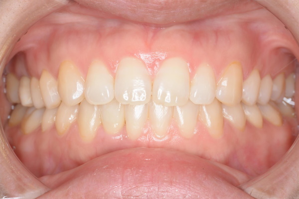 After image