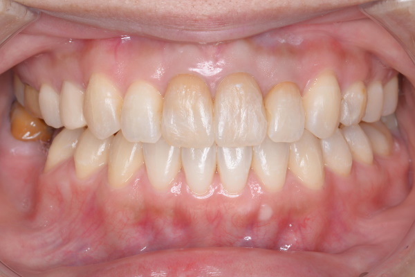 After image