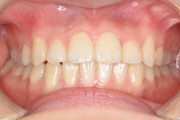 After image