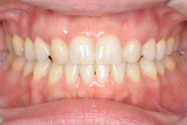 After image