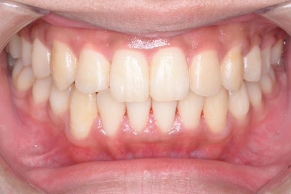 After image