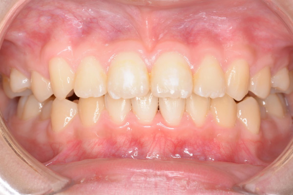 After image