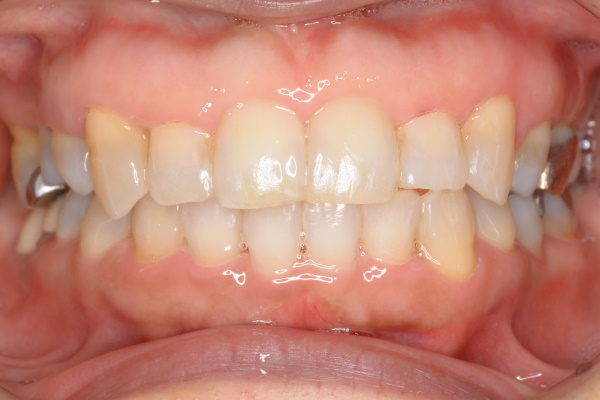 After image