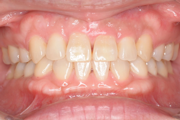 After image