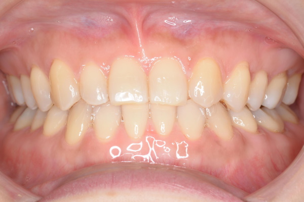 After image