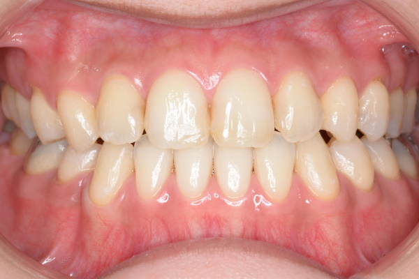 After image