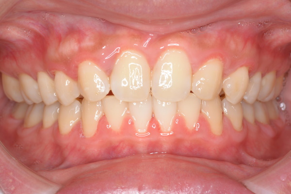 After image