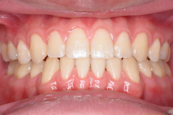 After image