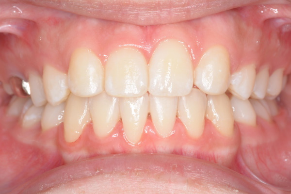 After image