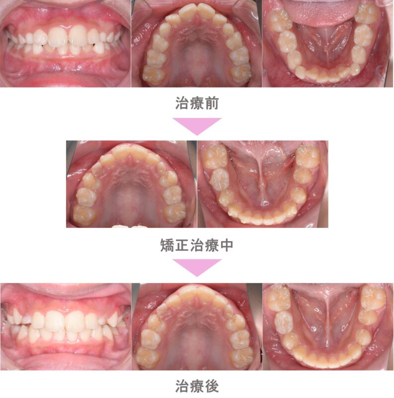 196 非抜歯矯正 非抜歯（歯を抜かない） | 二子玉川でインビザライン・裏側矯正