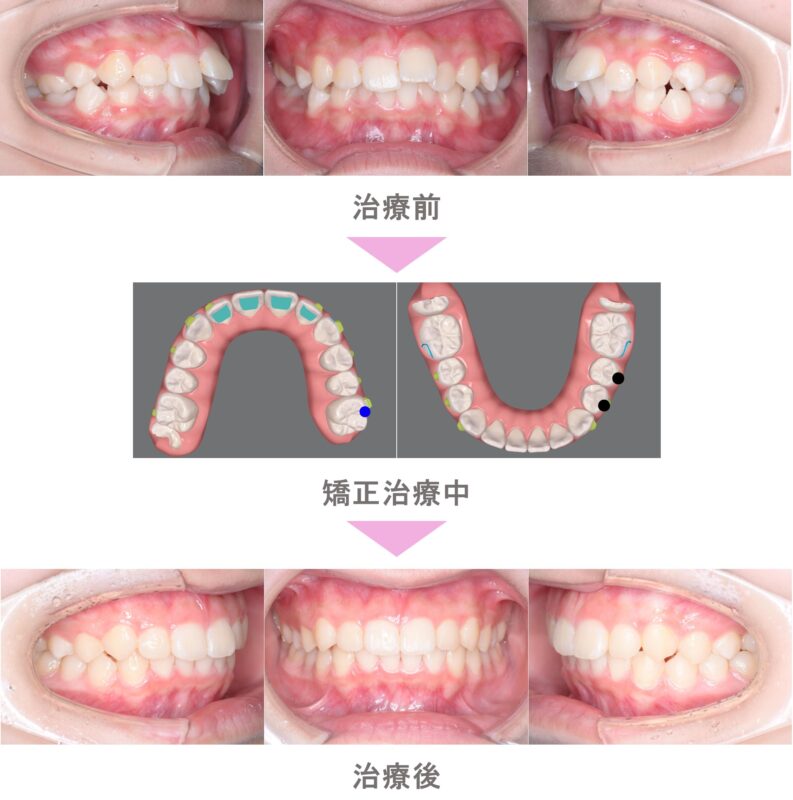 非抜歯（歯を抜かない） | インビザライン矯正・裏側矯正なら「二子